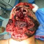 Blown off face surgery