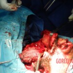 Blown off face surgery