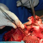 Blown off face surgery