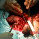 Blown off face surgery