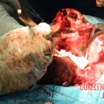 Blown off face surgery