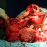 Blown off face surgery