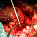 Blown off face surgery