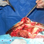 Blown off face surgery