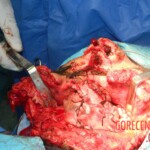 Blown off face surgery