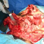 Blown off face surgery
