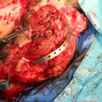 Blown off face surgery