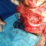 Blown off face surgery