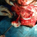 Blown off face surgery