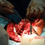 Blown off face surgery