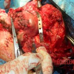 Blown off face surgery