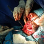 Blown off face surgery