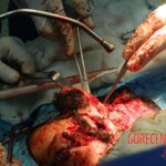 Blown off face surgery