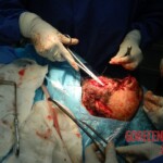 Blown off face surgery