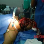 Blown off face surgery