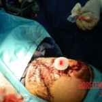 Blown off face surgery