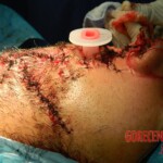 Blown off face surgery