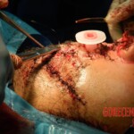 Blown off face surgery