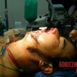 Blown off face surgery