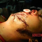 Blown off face surgery