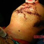 Blown off face surgery