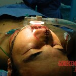 Blown off face surgery