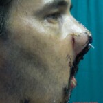 Blown off face surgery
