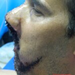 Blown off face surgery