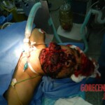 Blown off face surgery