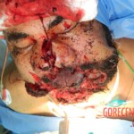 Blown off face surgery