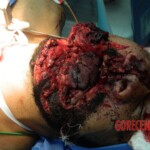 Blown off face surgery