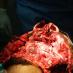 Blown off face surgery