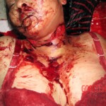 Slashed woman