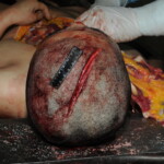 Machete attack victim