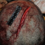 Machete attack victim