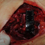 Machete attack victim