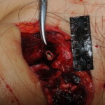 Machete attack victim