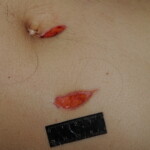 Machete attack victim