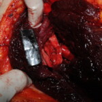 Machete attack victim