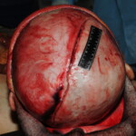 Machete attack victim