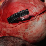 Machete attack victim