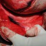 Machete attack victim