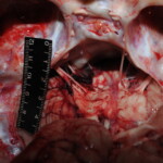 Machete attack victim