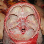 Machete attack victim