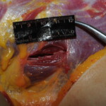 Machete attack victim