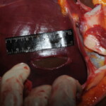 Machete attack victim