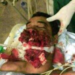 Plastic surgery of jaw after failed suicide attempt