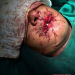 Plastic surgery of jaw after failed suicide attempt