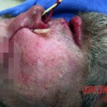 Surgical face reconstruction