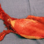 Surgical face reconstruction